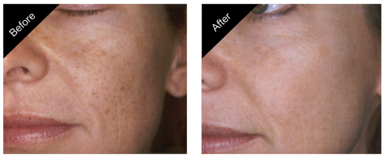ipl beforeafter