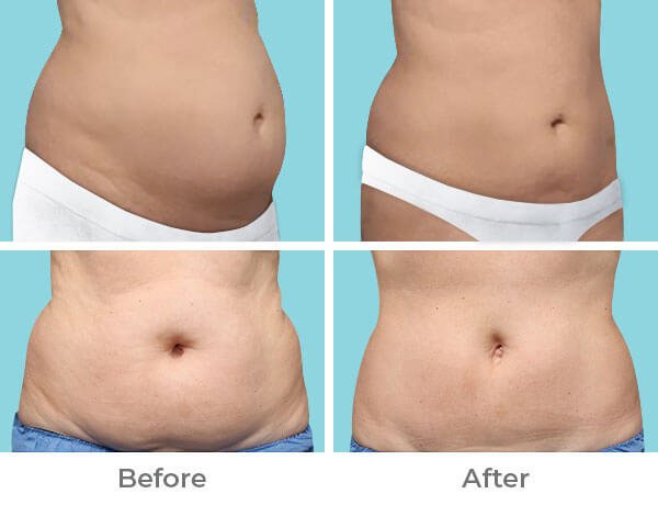 stubborn_fats_tummy before after